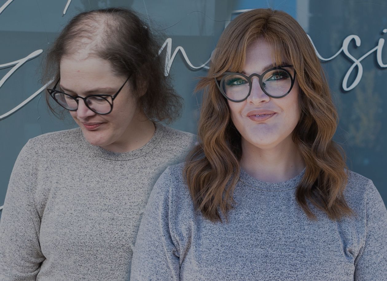Client before and after, alopecia